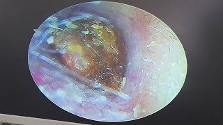 Cerumen embolism cleaning earwax Cleaning earwaxremoval satisfying [upl. by Hutchins]