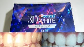 Guy with yellow teeth tests out whitening strips for 20 days Crest 3D Whitestrips [upl. by Assel]