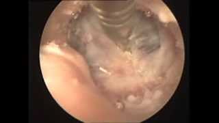 Secretory Otitis Media in Cavalier King Charles Spaniel [upl. by Ainna503]