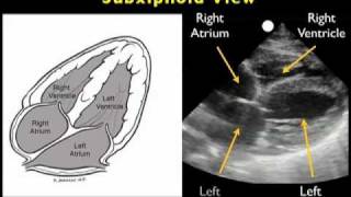 How to Echocardiography  Subxiphoid View [upl. by Drahsir]