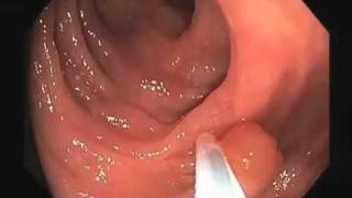 Colonoscopy Video Tour Removal of a Colon Polyp Polypectomy [upl. by Cymbre]