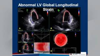 Echocardiographic Assessment of LV Diastolic Function Webinar [upl. by Grimonia]