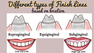 Types of Finish Lines based on Location Finish Lines in Fixed Partial Denture Tooth Preparation [upl. by Almira775]