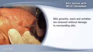 Removal of skin lesions with the MCL31 Dermablate erbium laser by Asclepion [upl. by Anattar55]