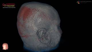 Resection of Brain Stem Cavernoma Minimally Invasive Surgery [upl. by Ramsden]