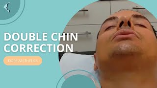 PDO threadlift double chin correction [upl. by Ainedrag]