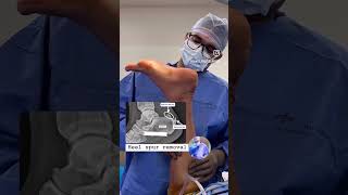 Heel spur removal fortishospitalmohali4685 orthopedics doctor sportsinjury [upl. by Aihsenyt526]