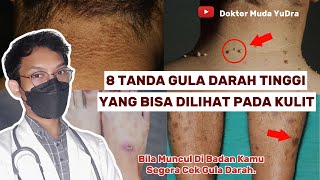 8 Tanda Kulit Kamu Mengalami Gula Darah Tinggi  DIABETES dokyudra [upl. by Nywled241]