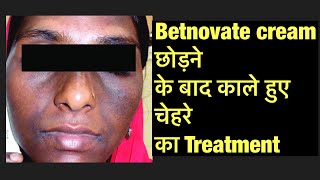 Betnovate c cream side effects  Steroid Cream से काले हुए चेहरे का Treatment [upl. by Calida51]