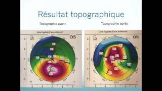 Photokératectomie thérapeutique PKT topoguidée sur le kératocône [upl. by Ettenil]