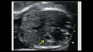 esophageal atresia [upl. by Margalo]