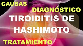 Tiroiditis de Hashimoto Fisiopatología Diagnóstico y Tratamiento [upl. by Nerfe957]