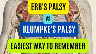 Erbs Palsy Vs Klumpkes Palsy  Brachial Plexus Injury  Easy Way To Remember [upl. by Ahsinor]