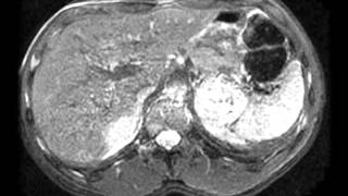 Pheochromocytoma [upl. by Nelubez939]