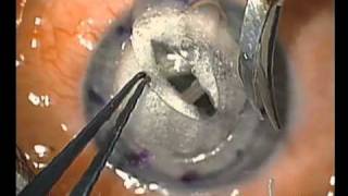 quotDouble Bubblequot Deep Anterior Lamellar Keratoplasty [upl. by Ailaht]