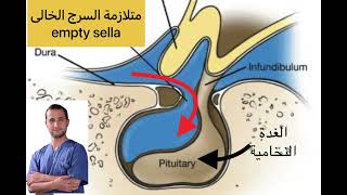 متلازمة السرج الخالى empty sella syndrome [upl. by Borer]