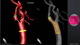 Angiografia cerebral normal [upl. by Anetsirk]