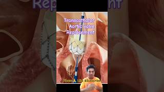 Aortic Valve Replacement animation satisfying cardiology viral aorticvalve shorts [upl. by Stander]