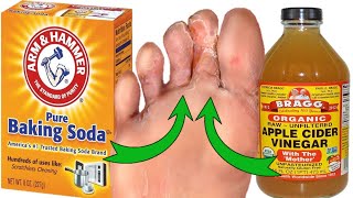 Say Goodbye to Athletes Foot Naturally Baking Soda amp Apple Cider Vinegar [upl. by Leamhsi]