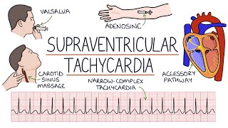 Understanding Supraventricular Tachycardia SVT [upl. by Haerdna]