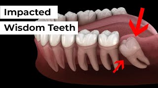 Full Wisdom Teeth Removal Procedure Emergency Extraction of Impacted amp Partially Erupted Molar [upl. by Steep]