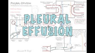 Pleural Effusion DETAILED  pathophysiology signs and symptoms treatment [upl. by Adnolat]