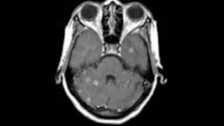 NEURORADIOLOGY CNS Infections  I  DEEPAK PATKAR  Tuberculomas vs Cysticercosis [upl. by Lsiel]