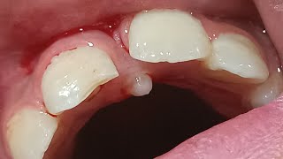 supernumerary tooth mesiodens  زوائد الاسنان [upl. by Fritzie]