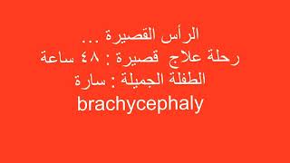 Brachycephaly correction [upl. by Orhtej]