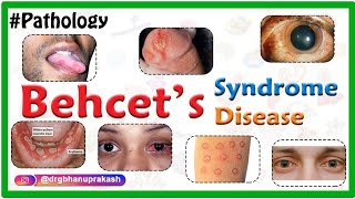 Behçet’s SyndromeBehcet Disease  Causes Pathology Clinical presentation Diagnosis and Treatment [upl. by Bernadina]