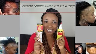 Comment FAIRE POUSSER les tempes degarnies [upl. by Aemat]