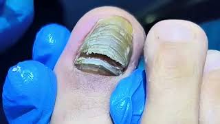 Painful Black Toenail Fungus Removal 【Yinuo Pedicure】 [upl. by Atika301]