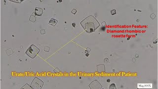 Urate Crystals or Uric acid Crystals in Urine Microscopy at various magnifications [upl. by Nnaik]