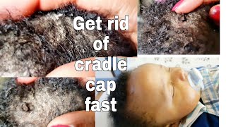 Cradle cap treatment  Cradle cap in babies [upl. by Tomkin]