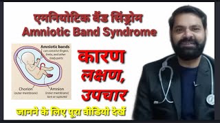 एमनियोटिक बैंड सिंड्रोम  Amniotic Band Syndrome cause symptoms and treatment in Hindi [upl. by Caneghem]