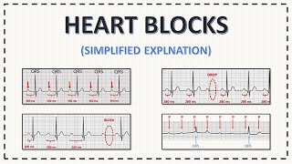 Heart Blocks ECG  AV Blocks ECG  Simplified Explanation with Examples [upl. by Adnawahs590]