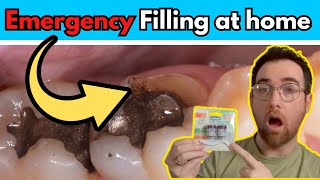 DIY Tooth filling Using Temporary filling material at home [upl. by Ettigirb]