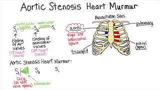 Aortic Stenosis  Part 2 Heart Murmur Series [upl. by Aicercul]