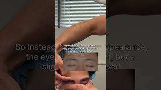 Eyebrow transplant immediately postop  Anthony Bared MD FACS  Miami FL [upl. by Eenert98]