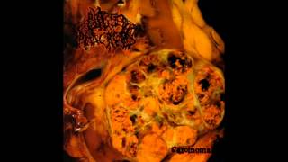 Blasted Pancreas  Carcinoma FULL ALBUM 2011  Pathological Goregrind [upl. by Alegnat995]