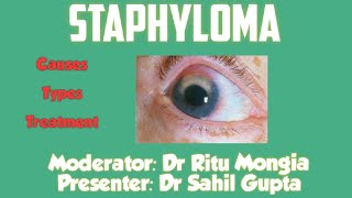 Staphyloma  Ophthalmology  For Medical Students [upl. by Eiznil]