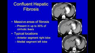 Ultrasound of Diffuse Liver Disease [upl. by Amuh663]