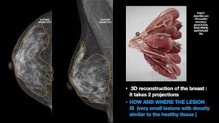 THE MAMMOGRAPHY FINDINGS PART ONE HOW AND WHERE [upl. by Cris]