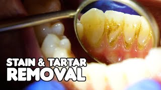 Dental Cleaning EXPLAINED  Stain amp Tartar Removal [upl. by Agrippina]