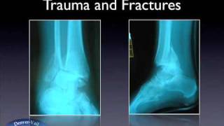 Treatment of Ankle Fractures [upl. by Alleirbag]