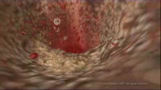 MEDICAL  How cholesterol clogs your arteries atherosclerosis [upl. by Brunk]