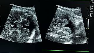 DandyWalker malformation prenatal ultrasound [upl. by Llet413]