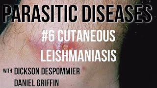 Parasitic Diseases Lectures 6 Cutaneous Leishmaniasis [upl. by Analim]