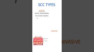 SQUAMOUS CELL CARCINOMA Types [upl. by Ltney394]