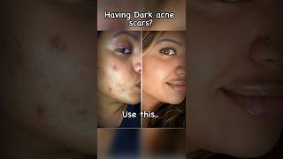 Dark acne scars remedy Adaferin gel viral skincare acnescars trending beauty acneremedy skin [upl. by Sass16]